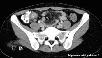 CT-scanner abdominal - Adénite mésentérique dans le cadre d'une iléite distale à Yersinia