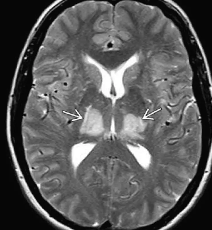 IRM T2 - encéphalopathie hypertensive avec lésions limitées aux thalamus (régression totale des lésions dans ce cas après abaissement agressif de la TA)