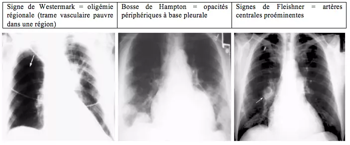Embolie pulmonaire - radiographies