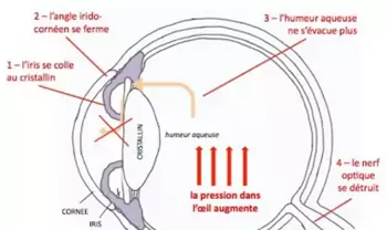 Glaucome aigu sur bloc pupillaire. Augmentation de la pression intra-oculaire secondaire à une diminution du flux de l'humeur aqueuse de la chambre postérieure vers la chambre antérieure du fait d'un contact entre l'iris et le cristallin.