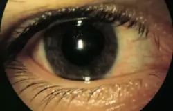 Glaucome aigu - oeil en mydriase avec cercle péri-kératique