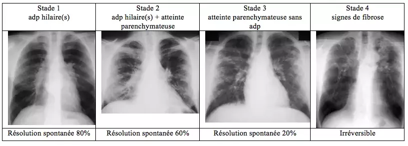 Sarcoïdose pulmonaire - radiographies thoraciques - stades radiologiques