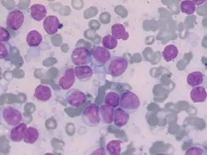 Maladie de Waldenström - biopsie médullaire - infiltration lympho-plasmocytaire