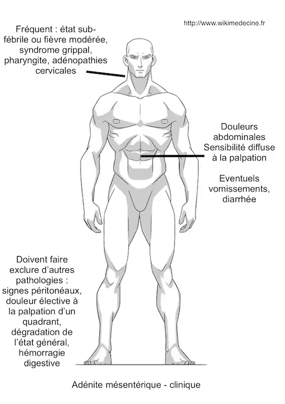 Adénite (= adénolymphite) mésentérique — Wikimedecine