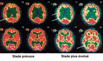 Maladie d'Alzheimer - PET-scan au FDG - développement d'un hypométabolisme diffus plus marqué en temporal