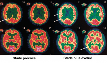 Maladie d'Alzheimer - PET-scan au FDG - développement d'un hypométabolisme diffus plus marqué en temporal