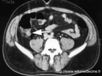 Appendicite aiguë - CT-scanner abdominal avec injection de produit de contraste - inflammation et ulcération appendiculaire