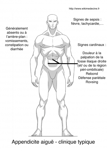 Appendicites — Wikimedecine