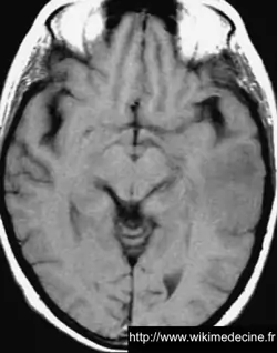 Astrocytome anaplasique (grade III) - IRM - T1 - zone hyposignal temporale gauche