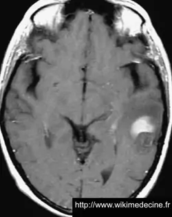 Astrocytome anaplasique (grade III) - IRM - T1 avec gadolinium - prise de contraste au centre d'une lésion hyposignal temporale gauche