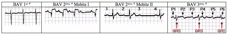 Blocs auriculo-ventriculaires (BAV)