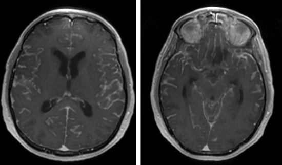 IRM - rehaussement diffus au gadolinium - méningite carcinomateuse