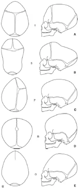 Les différents types de craniosténoses