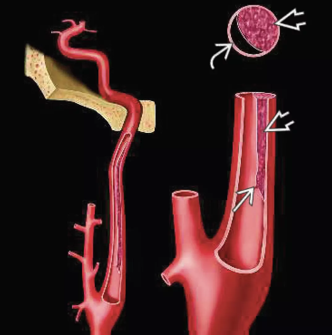 Dissection d'une carotide interne extracrânienne - rupture de l'intima, thrombus sous-intimal, réduction de la lumière artérielle
