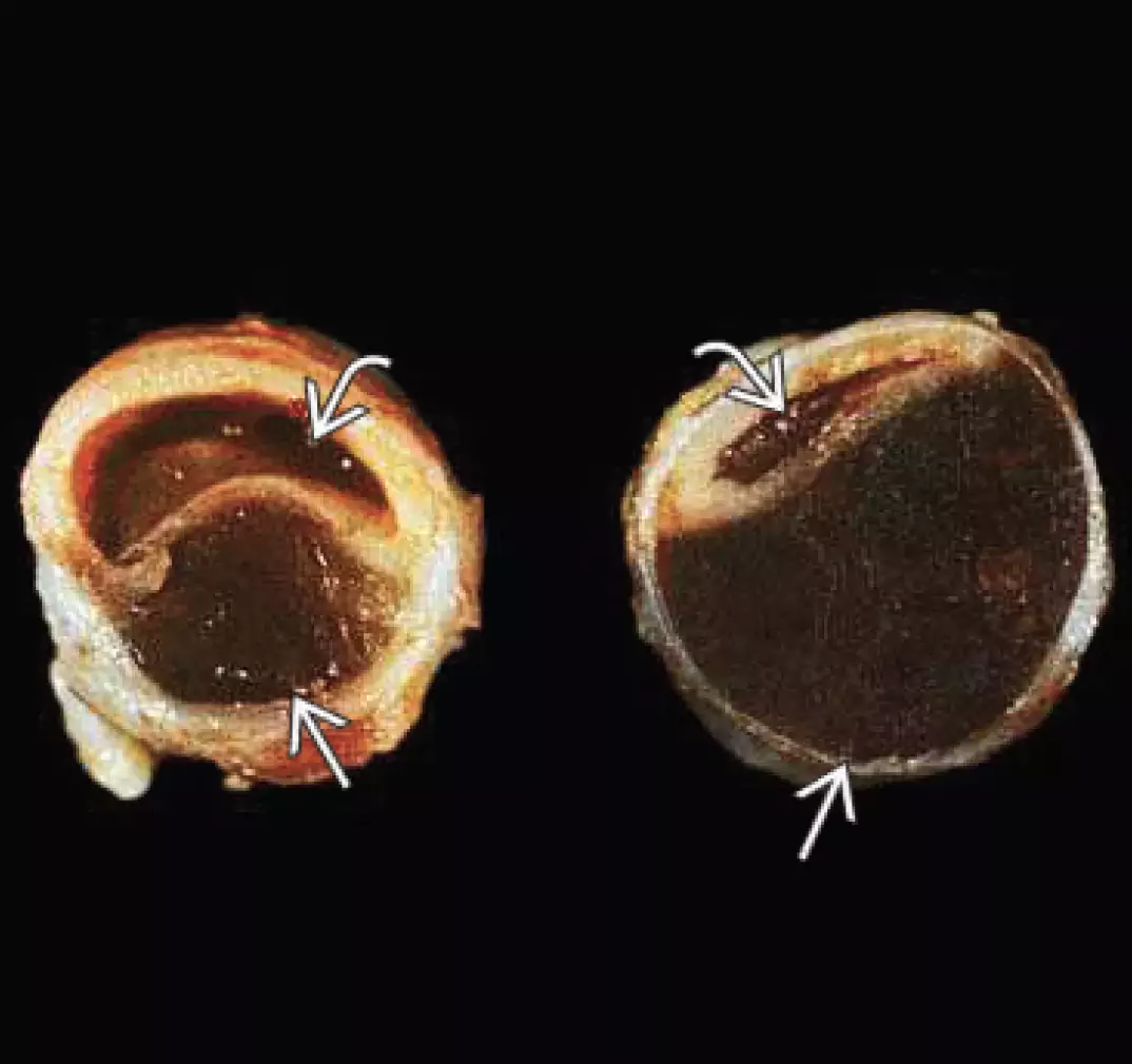 Pièce anatomopathlogique - section d'une carotide montrant un hématome sous-intimal déterminant une sub-occlusion artérielle
