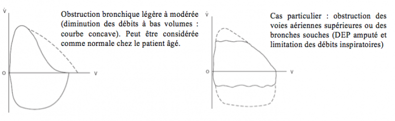 Epreuves fonctionnelles respiratoires (EFR) - Courbes débit-volume dans un syndrome obstructif