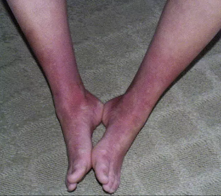 Erythermalgie - pieds