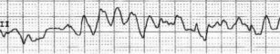 Fibrillation ventriculaire (FV)