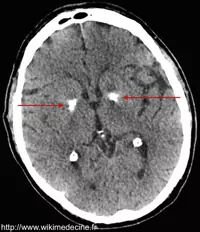 CT-scanner cérébral - Calcifications bilatérales des noyaux centraux