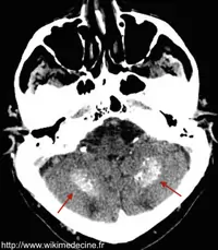 CT-scanner cérébral - Calcifications bilatérales cérébelleuses