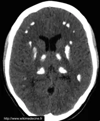 CT-scanner cérébral - Calcifications diffuses du parenchyme cérébral relativement symétriques