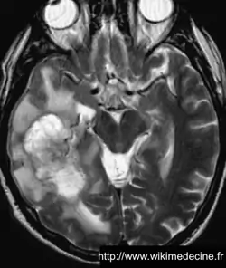 Glioblastome - IRM - T2 - large masse hétérogène hypersignal temporale droite entourée d'un oedème péri-lésionnel - image très suggestive d'un glioblastome