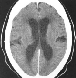 CT-scanner suggestif d'une hydrocéphalie : élargissement des ventricules latéraux disproportionné par rapport à celui des vallées sylviennes et hypodensités périventriculaires suggérant une résorption trans-épendymaire