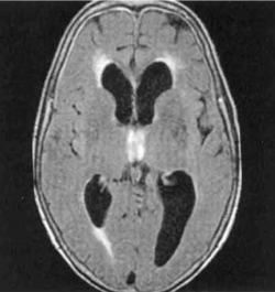 IRM - séquence FLAIR : ventriculomégalie disproportionnée par rapport à l'élargissement des sillons et hyper-intensités périventriculaires suggérant une résorption trans-épendymaire. L'absence d'autre anomalie est suggestif d'un tableau radiologique d'hydrocéphalie chronique de l'adulte idiopathique