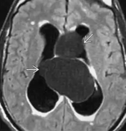 Hydrocéphalie obstructive - Kystes intraventriculaires obstruant le foramen de Monroe dans le cadre d'une neurocysticercose. On observe également des hyper-intensités suggérant une résorption trans-épendymaire - IRM - T1 C+ (gadolinium)