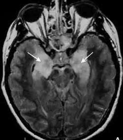Encéphalite limbique - IRM - séquence FLAIR - hypersignaux hippocampiques bilatéraux