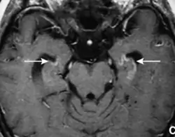 Encéphalite limbique - IRM - T1 C+ (gadolinium) - prise de contraste hippocampique bilatérale