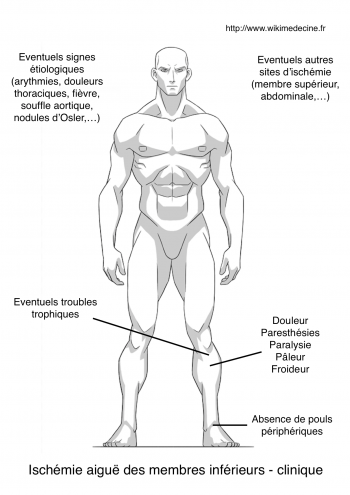 Ischémie des membres inférieurs - sémiologie clinique