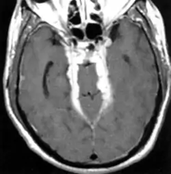 Neurosarcoïdose - IRM - T1 + gado : prise de contraste méningée multifocale correspondant à des granulomes sarcoïdosiques