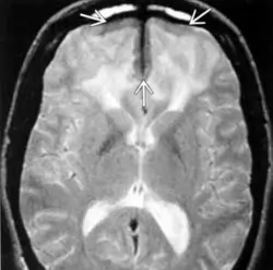 Neurosarcoïdose - IRM - séquence T2 : infiltration périventriculaire hyperintense aspécifique et bandes durales hypo-intenses correspondant à des granulomes sarcoïdosiques