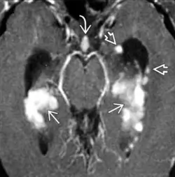 Neurosarcoïdose - IRM - séquence T1 avec gado - prise de contraste des plexus choroïdiens, de nodule à la surface épendymaire et de l'infidibulum correspondant à une infiltration sarcoïdosique. Hydrocéphalie modérée par ailleurs.