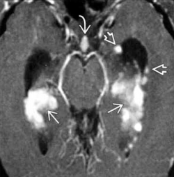 Neurosarcoïdose - IRM - séquence T1 avec gado - prise de contraste des plexus choroïdiens, de nodule à la surface épendymaire et de l'infidibulum correspondant à une infiltration sarcoïdosique. Hydrocéphalie modérée par ailleurs.