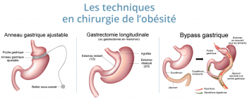 Obésité - exemples de chirurgies bariatriques