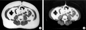 Obésité - CT-scanner - A : pondération montrant la graisse totale en surbrillance - B : pondération montrant uniquement la graisse viscérale en surbrillance