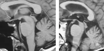 A gauche : IRM cérébrale normale. A droite : IRM cérébrale démontrant un "signe du colibri" (atrophie mésencéphalique et élargissement du quatrième ventricule) caractéristique d'une paralysie supranucléaire progressive.