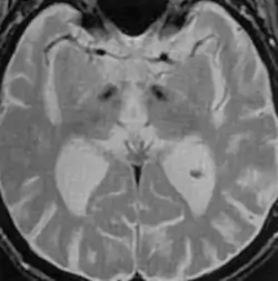 IRM cérébrale - séquence T2 - Maladie de Parkinson idiopathique - hypo-intensités de la substance noire
