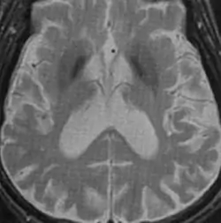 IRM cérébrale - séquence T2 - Maladie de Parkinson - hypo-intensités des globus pallidus et putamen