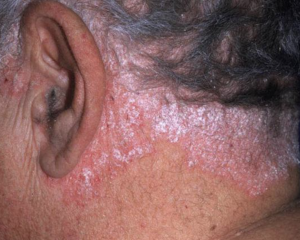 Psoriasis en plaque au niveau du crâne