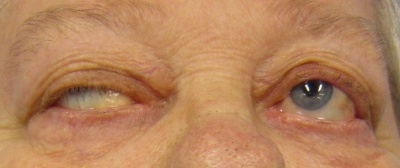 Ptosis.jpg