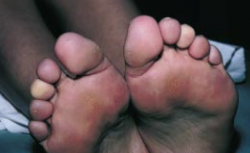 Phénomène de Raynaud - phase syncopale - pieds