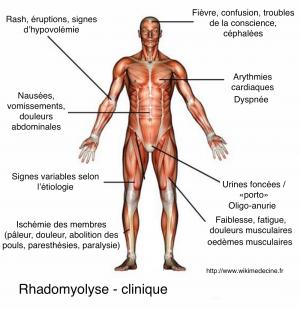 Rhabdomyolyse - sémiologie clinique