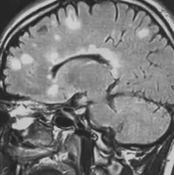 Sclérose en plaques (SEP) - IRM cérébrale - Séquence FLAIR - multiples lésions de la substance blanche et lésions évocatrices du corps calleux