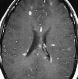 Sclérose en plaques (SEP) - IRM cérébrale - séquence T1 C+ (gadolinium) - multiples lésions de la substance blanche prenant le contraste
