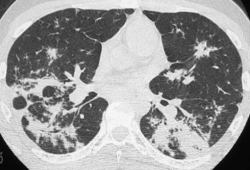 Sarcoïdose - CT-scanner thoracique - condensations alvéolaires irrégulières entourées de micronodules