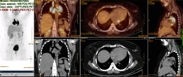 Sarcoïdose - PET-scan au FDG corps entier - multiples adénopathies hypermétaboliques hilaires et médiastinales, lésion focale hypermétabolique épicardiaque postérieure à la base du ventricule gauche, micronodule hypermétabolique pulmonaire postéro-apical droit