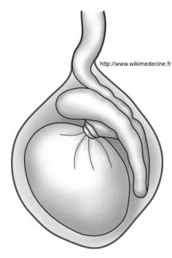 Torsion testiculaire interépididymotesticulaire